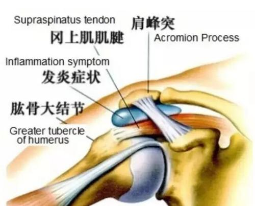 【健康科普系列二】肩周炎康復(fù)訓(xùn)練方法在這里